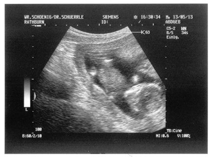 Ultrasound 13May2013a